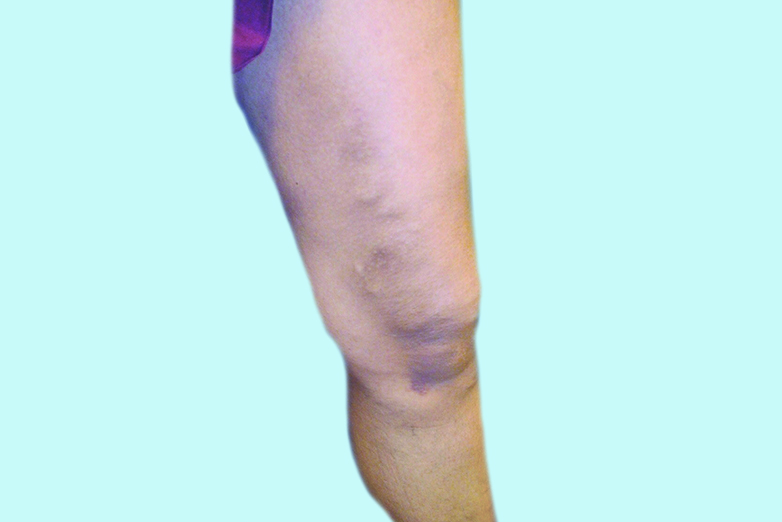 Varicose Veins, before and after
