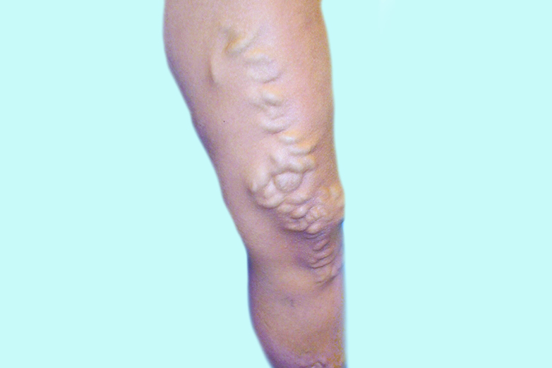 Varicose Veins, before and after